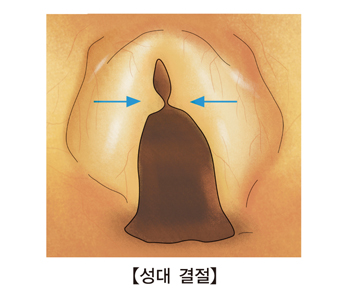 성대와 후두 결절