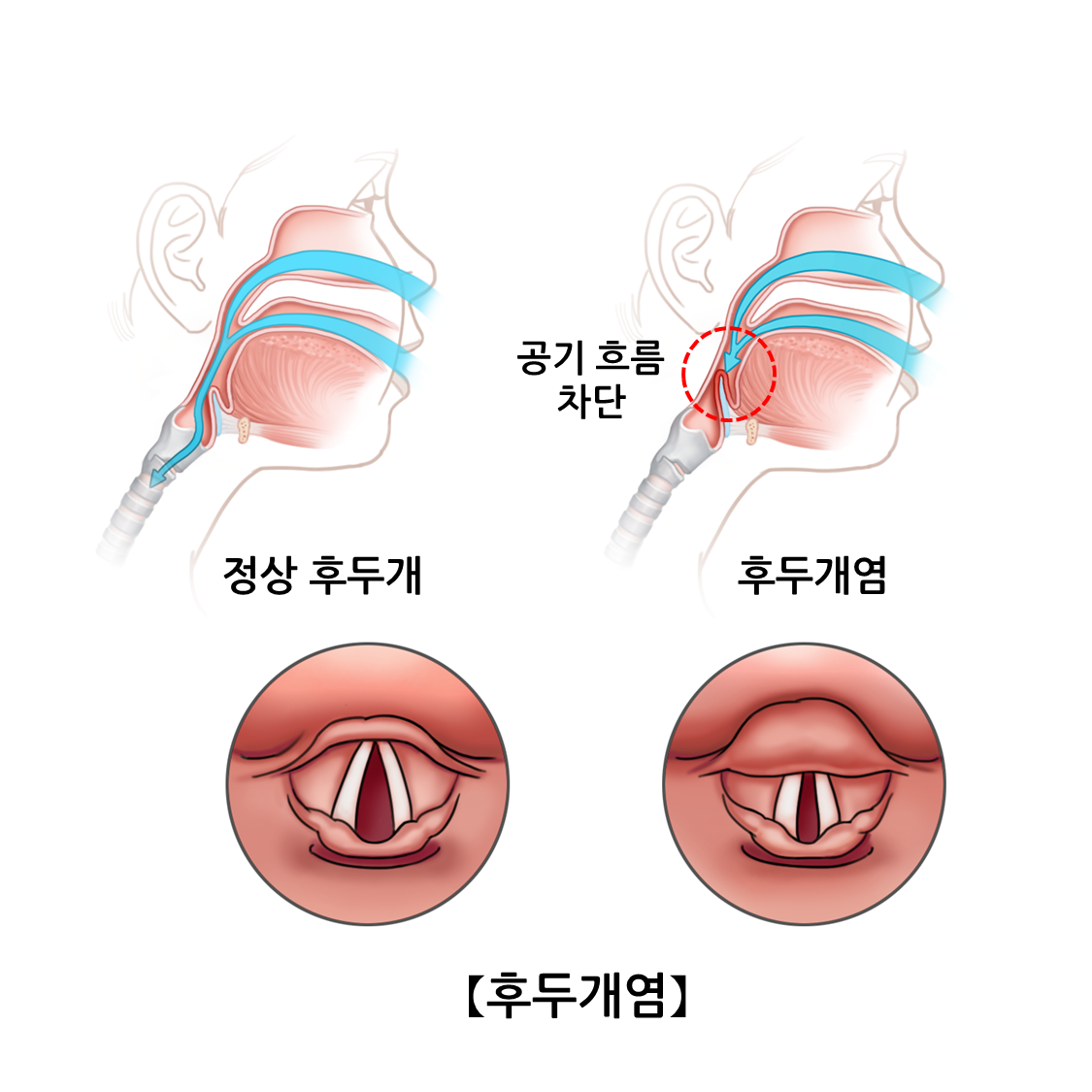 후두개염